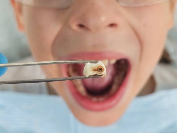 Best Emergency Dental Care for Broken or Chipped Teeth in Belle, WV